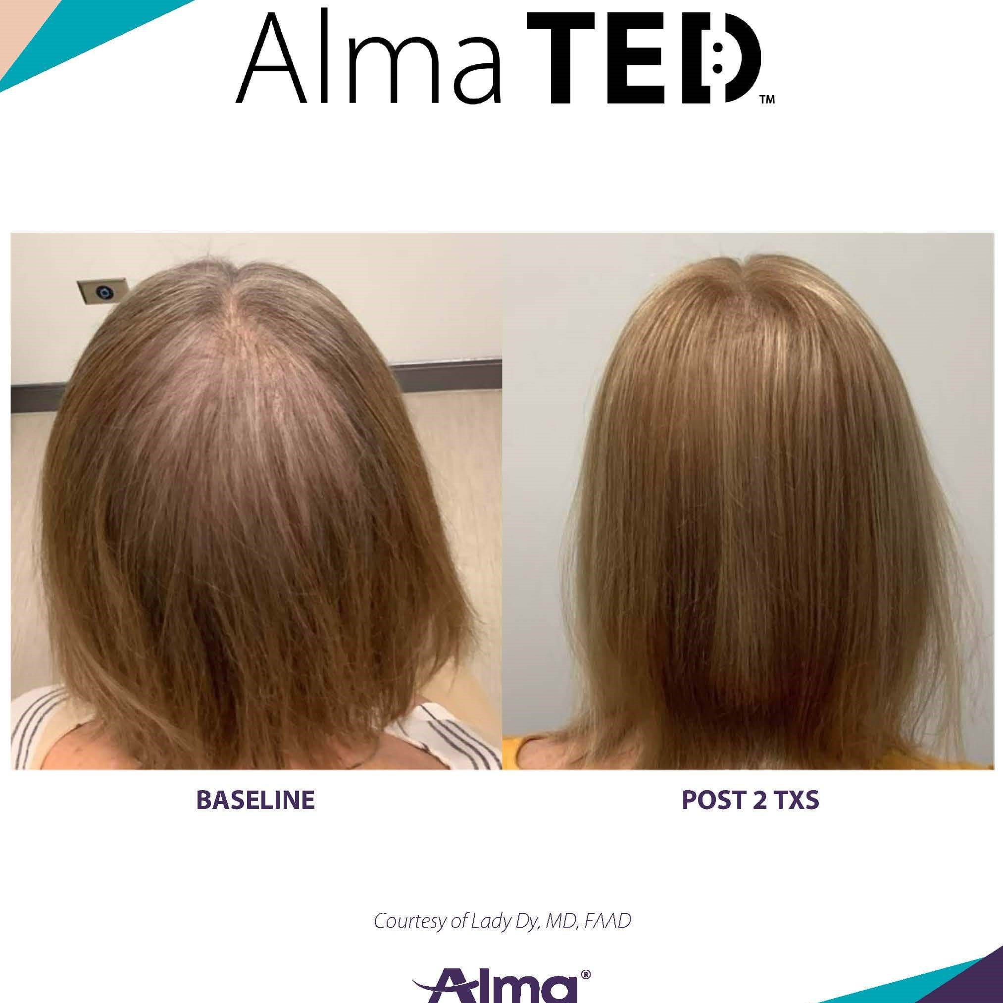 Results after 2 treatments